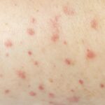 علائم فولیکولیت: جوش‌های قرمز و التهاب فولیکول‌های مو